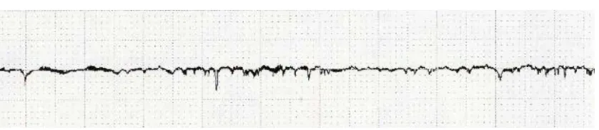 Gambar 9. Kekasaran Permukaan Camshaft Bagian Intake Cam Lobe  Hasil Penerapan Standar Dengan Ra 0,639 µm 