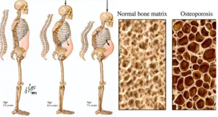 Gambar 1.  Penderita osteoporosis