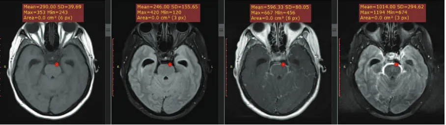Gambar Hasil MRI Salah Satu Subjek PenelitianMRI sekuens T1WI prekontras (A), T2-FLAIR prekontras (B), T1WI poskontras(C) dan T2-FLAIR poskontras