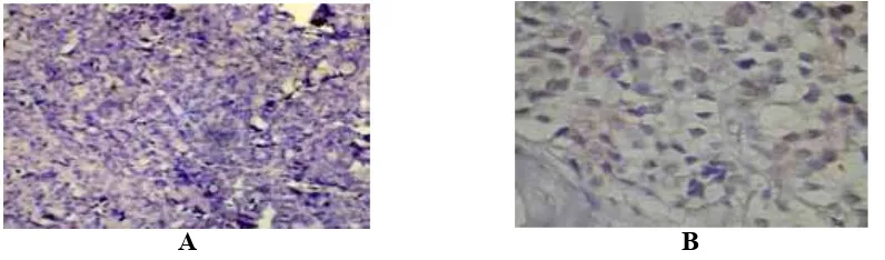 Gambar 2 Pulasan Imunohistokimia p53 pada KPDI yang Terekspresi 10–75% dengan Pembesaran 100x (A) dan 400x (B)