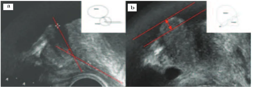 Fig. 1Measurement of PUA (a) and IPP (b) Using Ultrasound6