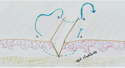 Fig. forms a loop to close the gap between wound edges.1a Complete Simple Interrupted Suture Appearance