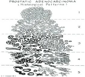 Fig. 1Gleason Score from Lower to Higher.1 Gleason Pattern 1: Circumscribed Nodule of Closely Packed Uniform Glands, Gleason Pattern 2: Circumscribed Nodule of Loosely Packed Slightly Variable Glands, Gleason Pattern 3:  Single Glands of Variable Size and Density, with an Infiltrative Pattern, Each Separated by at Least a Strand of Stroma, Gleason Pattern 4: Ragged Infiltration with Poorly Formed Glands or Sheets and Cords of Fused Glands, Poorly Formed Glands Includes Small Nests of Cells with only a Rudimentary Formed Lumenal Space (almost Rosette Like), Gleason Pattern 5: Ragged Infiltrative Single cells, Cords or Sheets, Granular