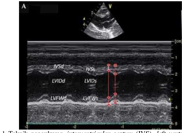 Gambar 1 Teknik pengukuran  intraventricular septum (IVS), left ventricular internal 