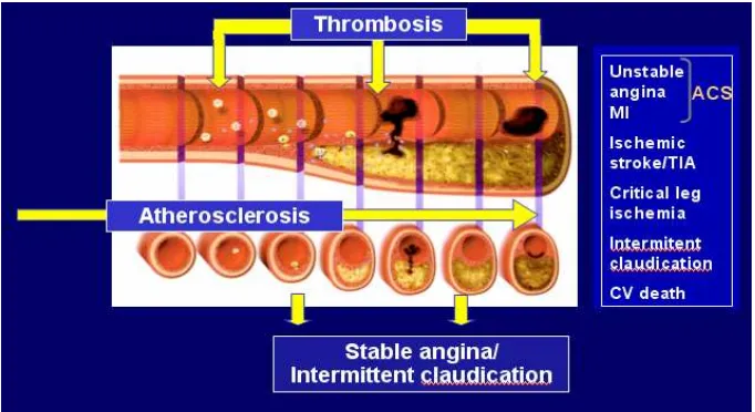 Gambar 2.  Perjalanan Proses Aterosklerosis ( Initiation, Progression dan Complication) Pada Plak Aterosklerosis 