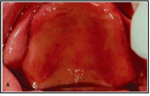 Gambar 6. Denture stomatitis pada palatum2 
