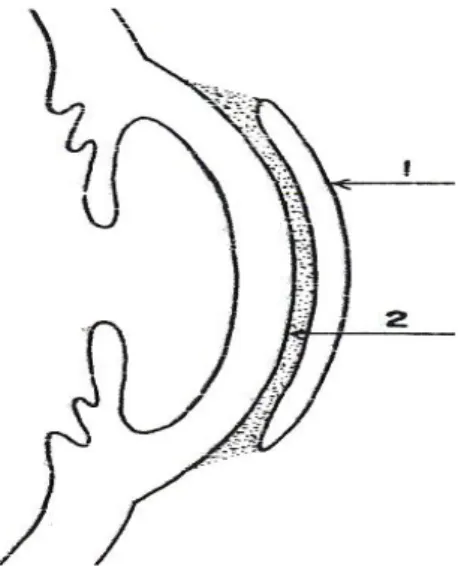 Gambar 3 : Lensa air mata (  Stephens GL, Spectacles Lenses, Duane’s Clinical Opthalmology,                                                                                Chapter 54, Vol 1, Lippincott Williams &amp; Wilkins, 2004, 21) 