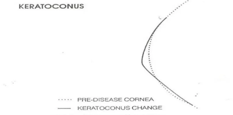 Gambar 2. Progresifitas mata keratokonus dan lensa kontak pada keratokonus  