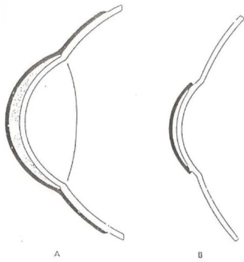 Gambar 1. (a) Lensa kontak skleral (b) Lensa kontak kornea  
