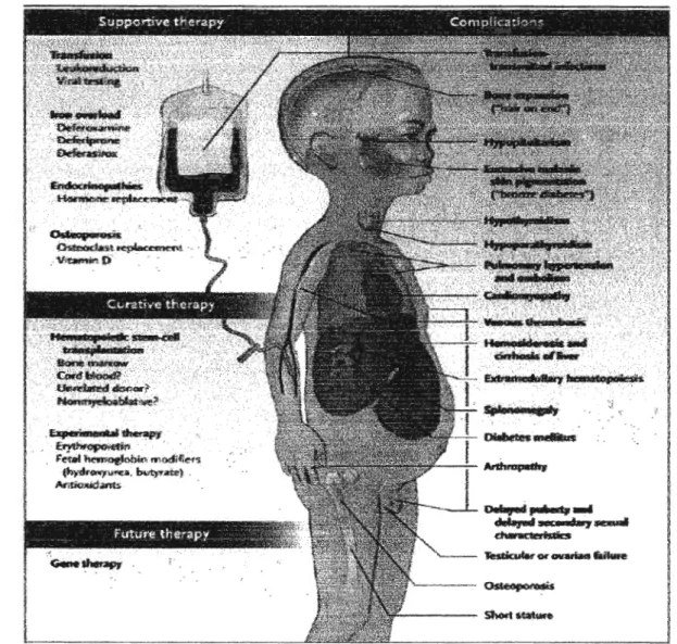 Gambar 1. Pengobatan Thalasemia dan komplikasinya  (NFJM  2005;353:135-46). 