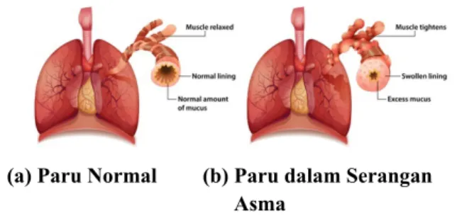 Gambar 1. Struktur anatomi bronkus normal (a) dan  saat terjadi serangan asma (b). 12