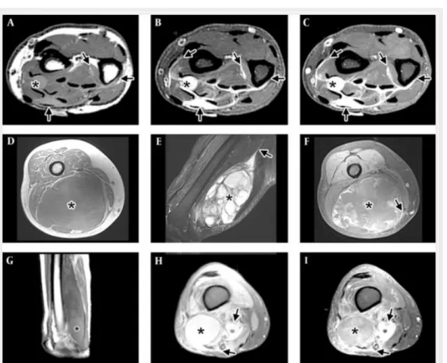 Gambar  4.  Pola  gambaran  myxofibrosarcoma.  A-C.  Pola  infiltratif  pada  distal  antebrachii,  dengan  gambaran  tail  sepanjang  fascial  planes  (panah)  di  atas  nodul  kecil  (*)