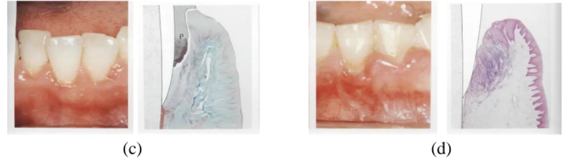 Gambar 2.3 : Gambaran klinis dan histopatologi (a) gingiva sehat, (b) gingivitis ringan, (c) gingivitis 