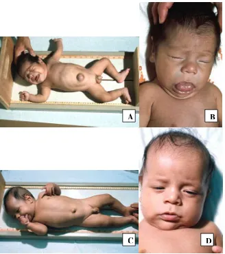 Gambar 2. A dan B. Bayi dengan hipotiroidisme kongenital, ikterus, lidah besar, wajah 
