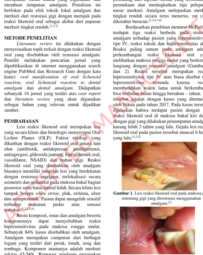 Gambar 1. Lesi reaksi likenoid oral pada mukosa pipi  setentang gigi yang direstorasi menggunakan 