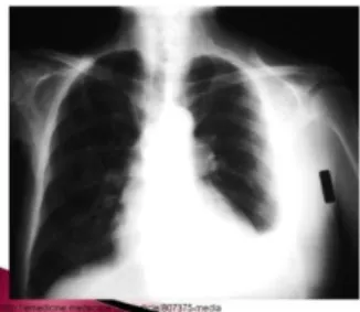 Gambar 2.2.9 Hemopneumothorax 21  2.2.10  Cardiac Lesion 
