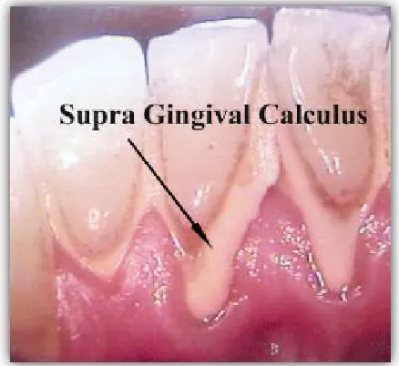 Gambar 2.1: Kalkulus supra gingival.5 