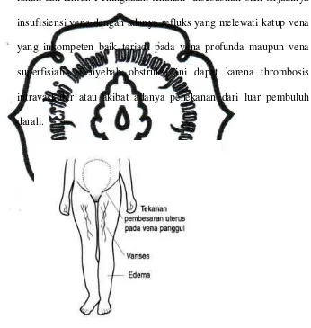 Gambar 2.3 Varises pada kehamilan 