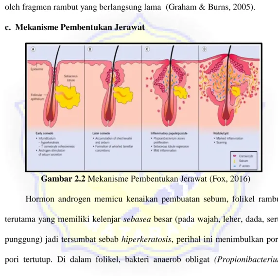 Gambar 2.2 Mekanisme Pembentukan Jerawat (Fox, 2016) 