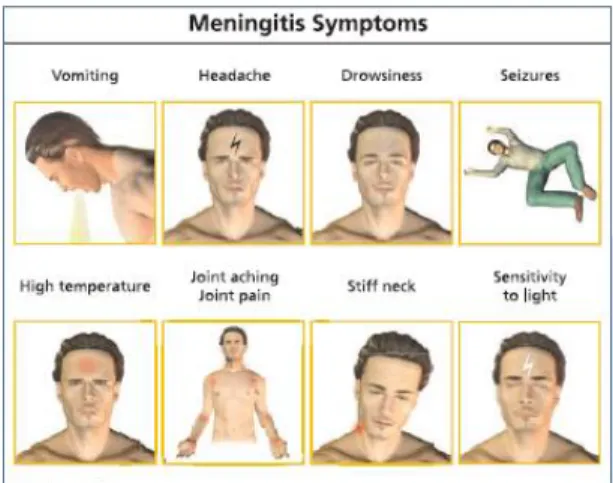 Gambar 2.3 Gejala Meningitis meliputi mual, dan muntah, sakit kepala, demam, dan kaku  kuduk 