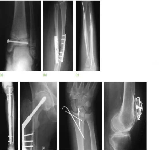 Gambar  6.  Fiksasi  Internal.  a)  Screws,  b)  plate  and  screws,  c)  flexible  intermedullary nail d) interlocking nails and screws, e) dynamic compression srew  and plate, f) K-wires, g) tension-band wiring 