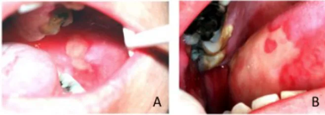 Gambar 1. Lesi mukositis oral pada mukosa (A) bukal 