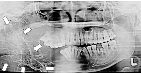 Gambar  3.	 Citra	 aksial	 pada	 contrast-enhanced  CT	 (CECT)	