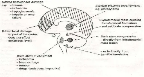 Gambar 1. Patofisiologi penurunan kesadaran 