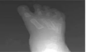 Gambar 1. deformitas equinus dan varus4