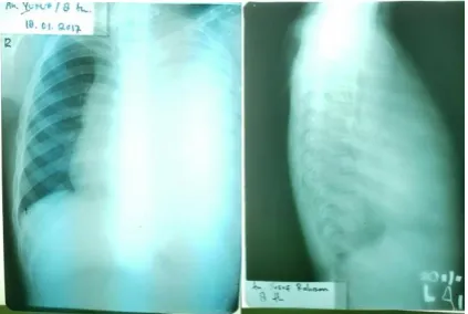 Gambar 1. Hasil rontgen torax pasien (AP dan Lateral) 