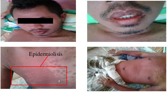 Gambar 4. Gambaran klinis pasien Stevens-Johnson Syndrome-Toxic Epidermal Necrolisis 