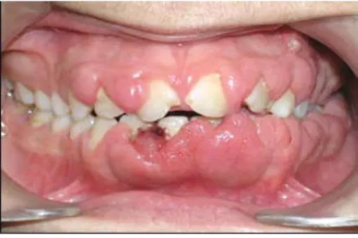 GAMBAR 2.10 Pembesaran Gingiva (Sumber : Periodontology for the Dental Hygienist 3 rd ed