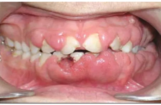 GAMBAR 2.12.(a) Hiperplasia Gingiva (Sumber: : Periodontology for the Dental Hygienist 3 rd ed