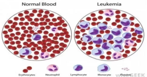 GAMBAR 2.1. Perbedaan Sel darah Merah Normal dan Sel darah penderita Leukimia.(Sumber :