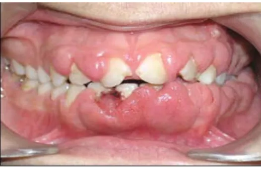 GAMBAR 2.3 Pembesaran Gingiva pada pasien leukemia. (Sumber : Periodontology for the Dental Hygienist 3 rd ed
