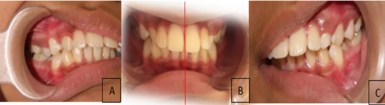 Gambar 1. Foto Intra Oral, A. Gigitan kanan pasien; B. Tampak depan; C gigitan kiri pasien