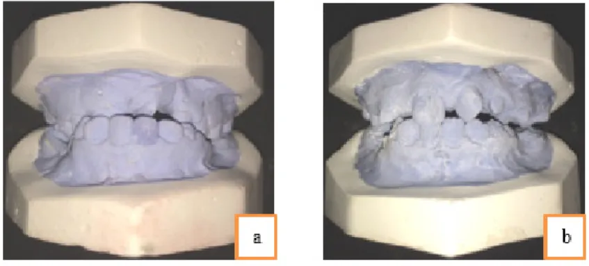 Gambar 7. Koreksi crossbite anterior dan posterior : (a) sebelum perawatan; (b) setelah perawatan