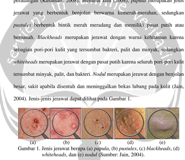 Gambar 1. Jenis jerawat berupa (a) papula, (b) pustules, (c) blackheads, (d)     whiteheads, dan (e) nodul (Sumber: Jain, 2004)