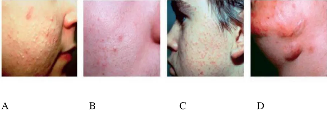 Gambar 2.1 Berbagai tipe lesi akne vulgaris (Zaenglein et al., 2008). 
