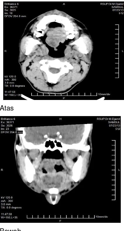 Gambar 3. CT Scan Potongan Aksial (atas) 