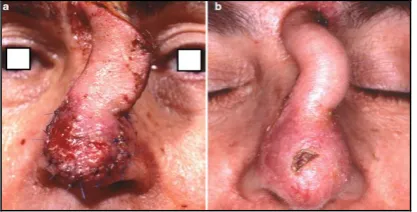 Figure 6a & 6b. Epidermolysis of   