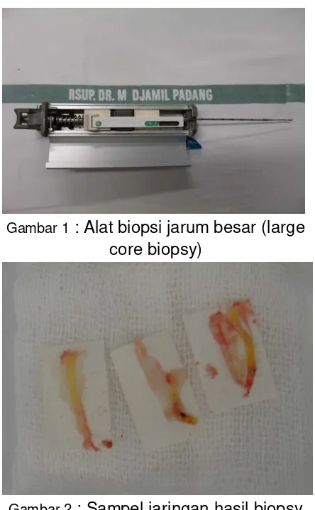 Gambar 2 : Sampel jaringan hasil biopsy jarum besar 