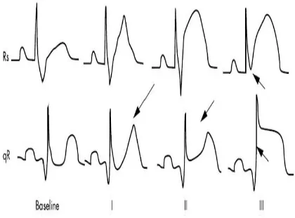 Gambar 2. Derajat Iskemia pada Pola EKG Rs dan qR.3 