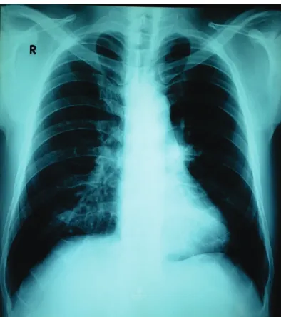 Gambar 2. Rontgen Thorak PA memperlihatkan gambaran hilus kasar dengan corakan bronkovaskuler yang meningkat serta bercak lunak di perihiler kanan dan parakardial kanan