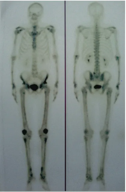 Gambar 5. Sidik tulang: Penangkapan tulang panjang) dan pada sendi humeri, genu, pergelangan tangan, dan kaki.os tibia, os fibula, lengan bawah (tulang-radioaktivitas yang meningkat difus dan bilateral pada distal dan metafise  os femur,  