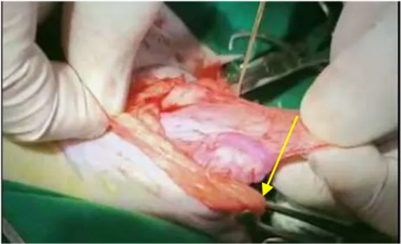 Gambar  2.  Area  cincin  hernia  telah  terbungkus  oleh  kapsul  dan  membentuk  pembuluh  darah  (panah)