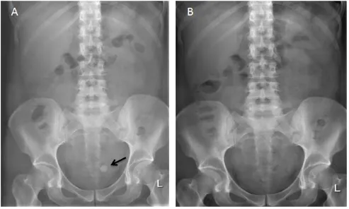 Figure 1.  (A) Plain X-ray of patient with bladder stone (as indicated by black arrow); (B) Plain X-ray two weeks after last extra-corporeal shockwave lithotripsy (ESWL) session