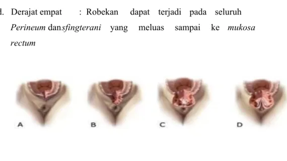 Gambar 2.1 Derajat Robekan Perineum 