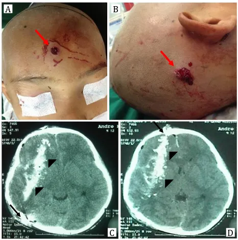 Figure 1.  A,B) Missile enters from mid frontal and comes out 