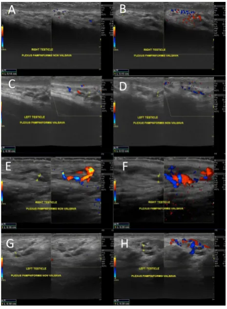 Figure 2. ing plexus pampiniform diameter at less than 3 mm in re-laxed supine position